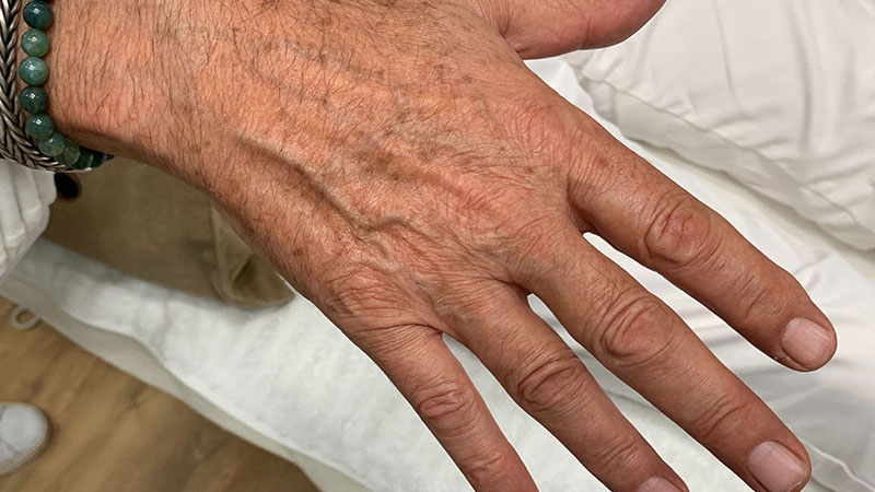 Laser Pigment removal