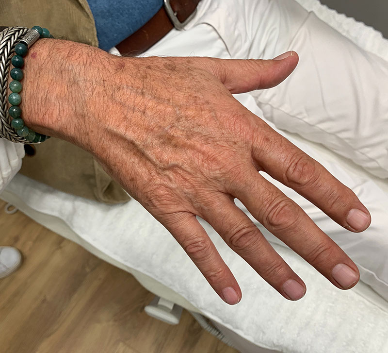 Pigmentbehandeling