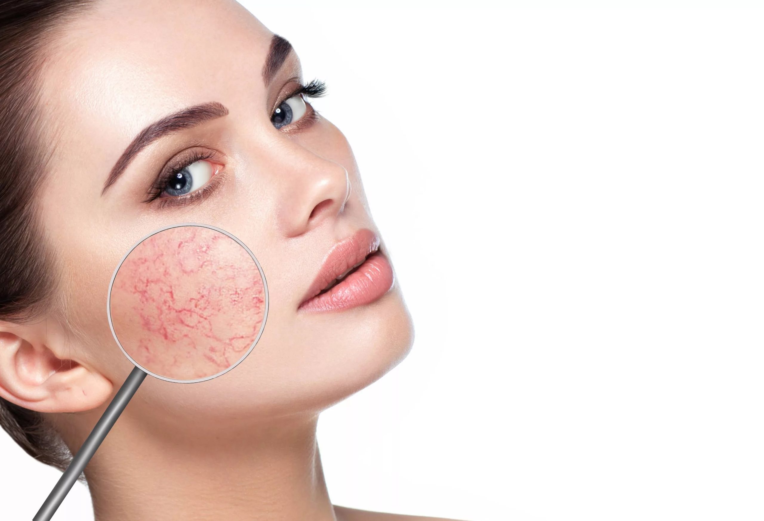 Rosacea & roodheid
